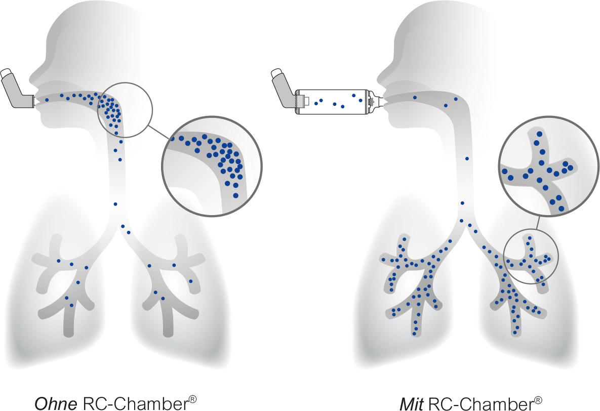 Vergleich der Medikamentenverteilung mit und ohne RC-Chamber®